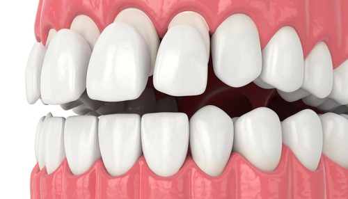 3d render of jaw with teethand upper veneers