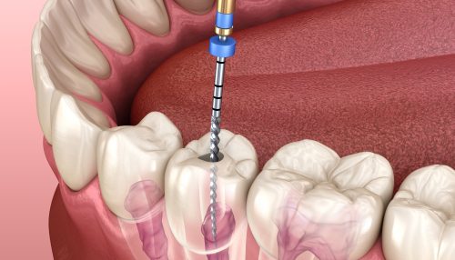cc-dental-root-canal-diagram - diaries dental Clinic