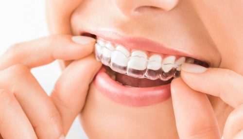 clear aligners
