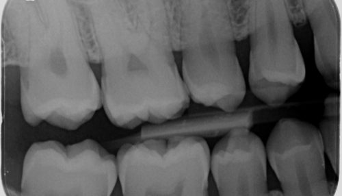 dental xray - diaries dental