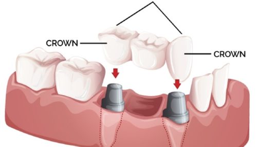 diaries dental clinic crowning and bridging