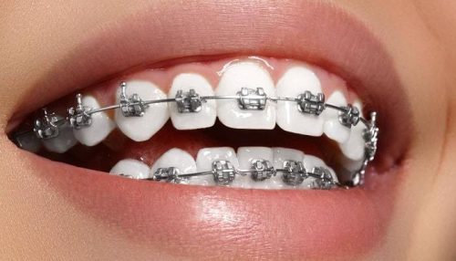metalic braces by diaries dental clinic