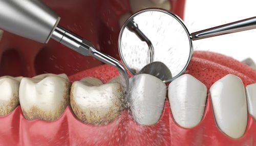 Professional teeth cleaning. Ultrasonic teeth cleaning machine delete dental calculus from human teeth.