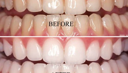 teeth-whitening - diaries Dentalc clinic