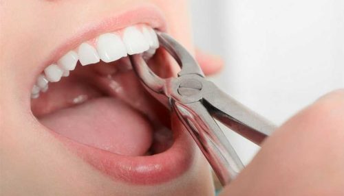 tooth surgery - diaries dental clinic