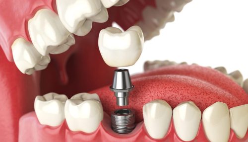 types-of-dental-implants-which-one-is-best-for-you - diaries dental clinic
